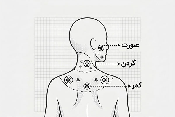 جوش بدن در کدام قسمت‌ها ایجاد می‌شود
